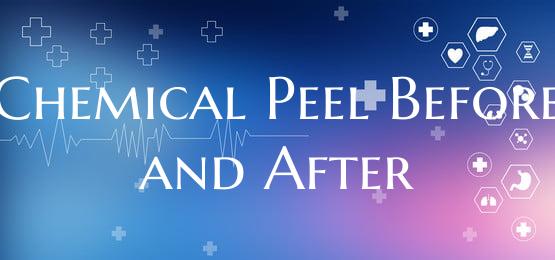 Chemical Peel Before and After