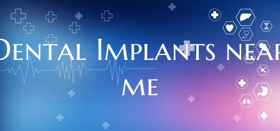 Dental Implants near me