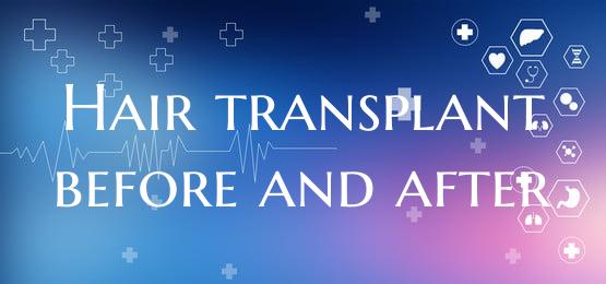 Hair transplant before and after