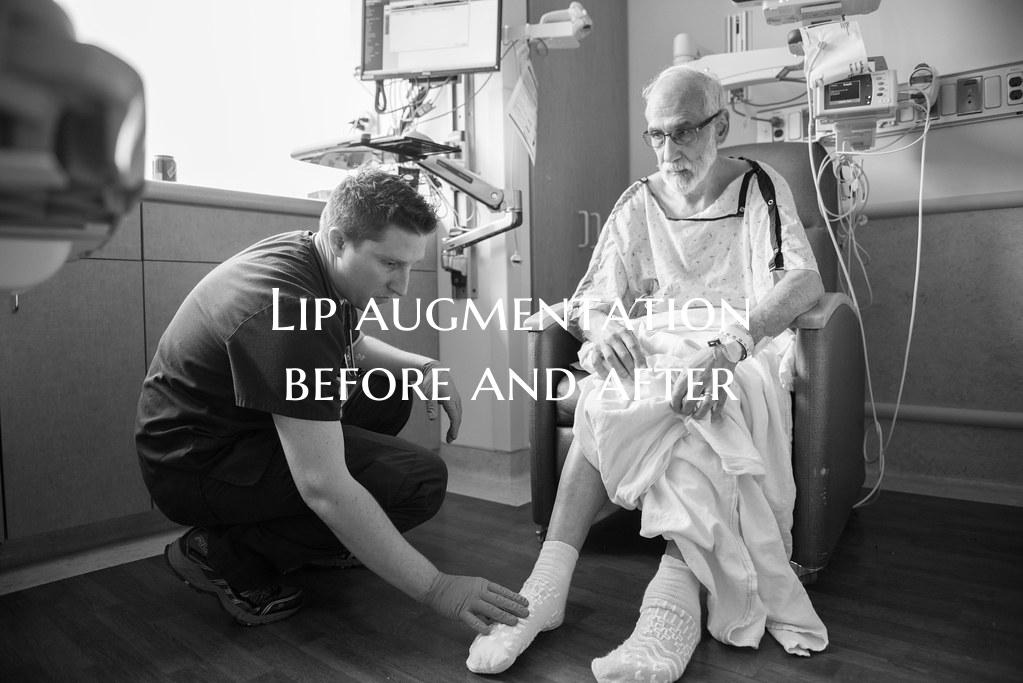 Lip augmentation before and after