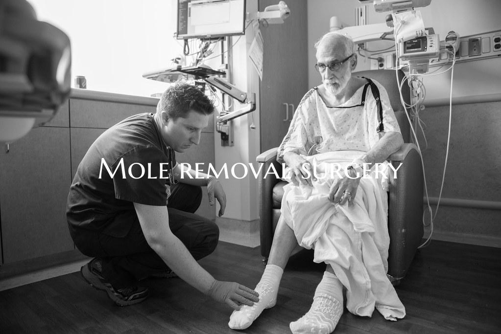 Mole removal surgery
